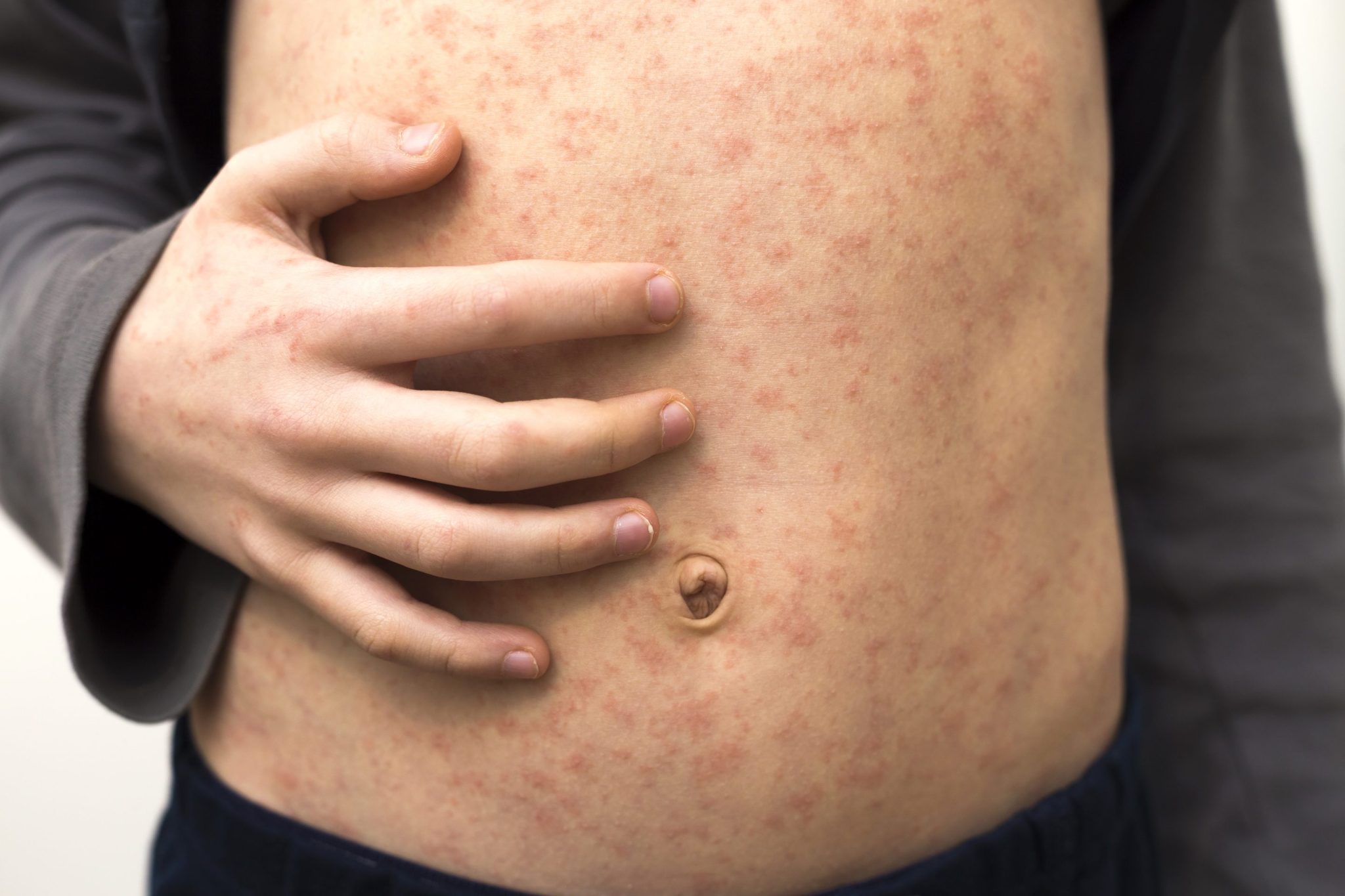 Measles cases are mounting in the US as the UK declares a ‘national incident’ over the disease. What parents need to know to keep their kids safe